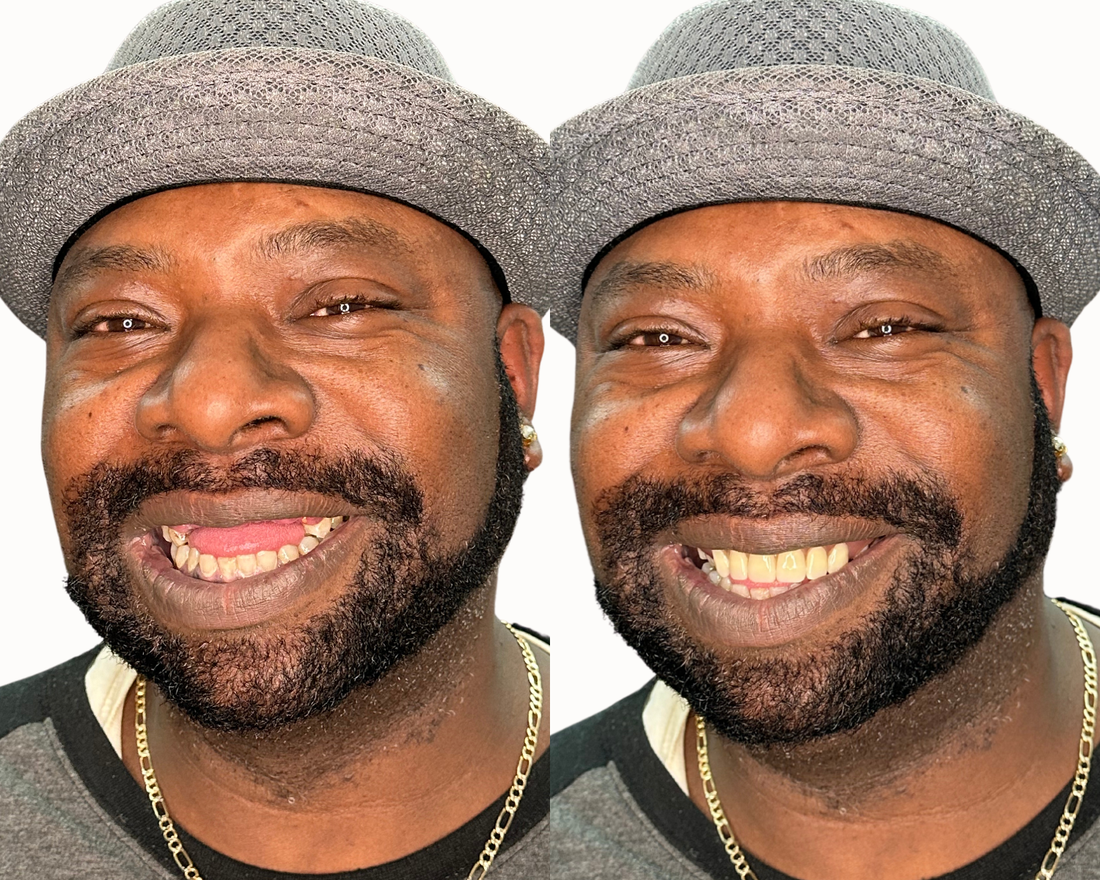 Overcoming the Struggles of Missing Teeth: How to Regain Confidence and Happiness