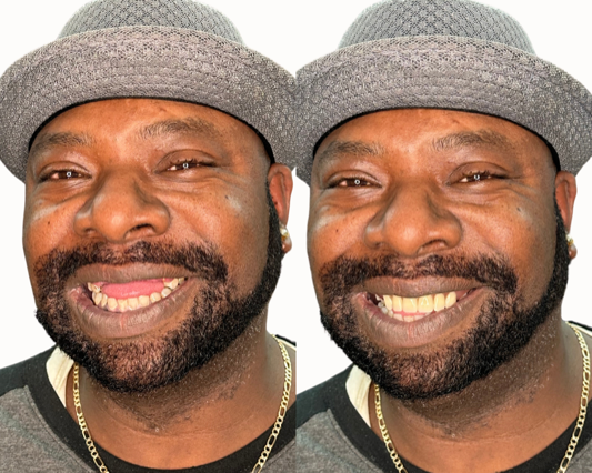 Overcoming the Struggles of Missing Teeth: How to Regain Confidence and Happiness