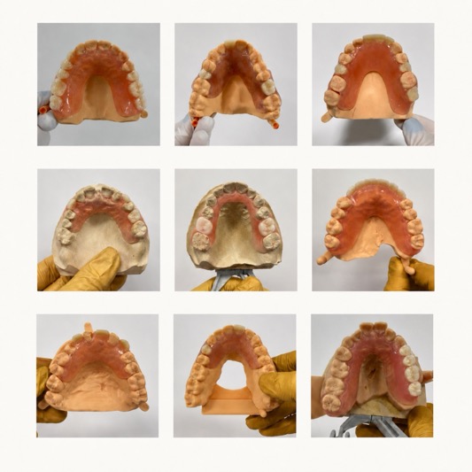 Types of Dentures Offered by Smile Lab USA: A Comprehensive Guide
