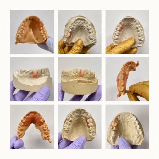 Cheapest Option for Missing Tooth: Affordable Solutions from Smile Lab USA