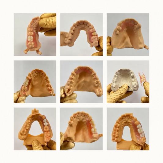 Why Dentures Might Suit Patients Better Than Implants or Bridges