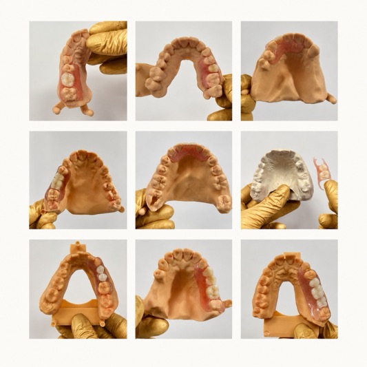 Why Dentures Are a Better Choice Than Implants: Fast, Budget-Friendly, and Painless