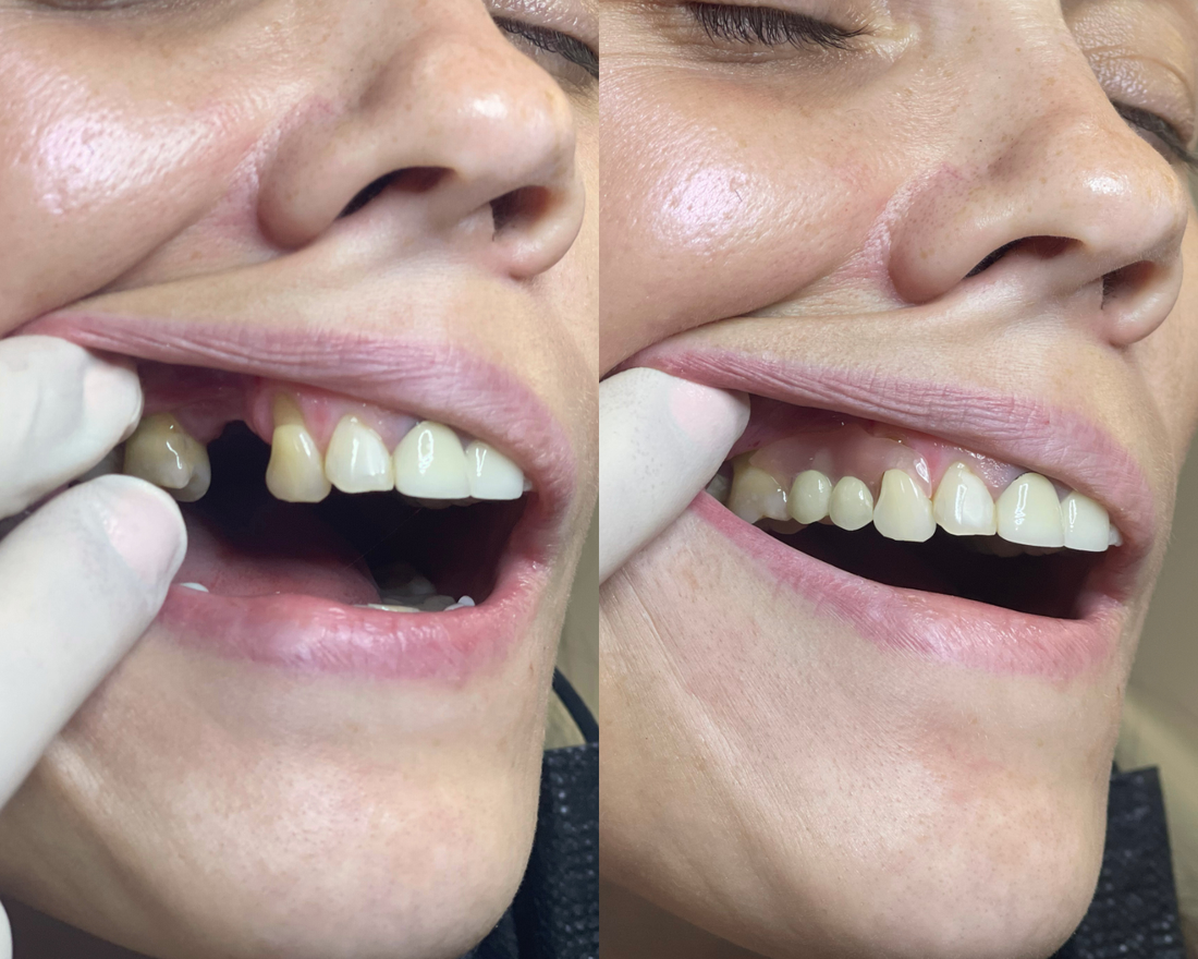 Ultimate Guide to Tooth Extraction: Foods to Avoid, Healing Time, and Cost Breakdown