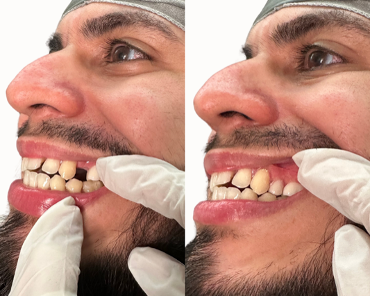 Affordable Tooth Replacement Options for Missing Teeth: Smile with Confidence at Smile Lab USA
