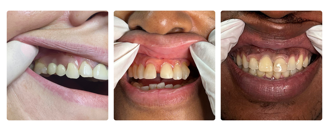 Why Modern Dentures Are Redefining Smiles: A Smile Lab USA Perspective