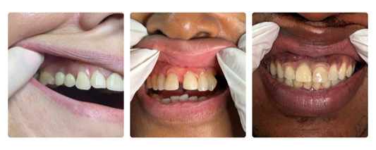 Why Modern Dentures Are Redefining Smiles: A Smile Lab USA Perspective