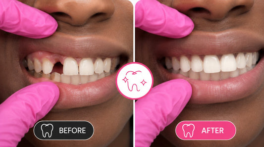 Before and after flipper tooth transformation for a missing front tooth, demonstrating how a custom removable tooth replacement can restore the appearance of a complete smile.