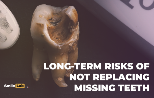 Decay and bone loss on an extracted tooth, the long-term cost of leaving a gap
