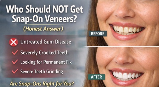 Who Should NOT Get Snap-On Veneers? (Honest Answer)