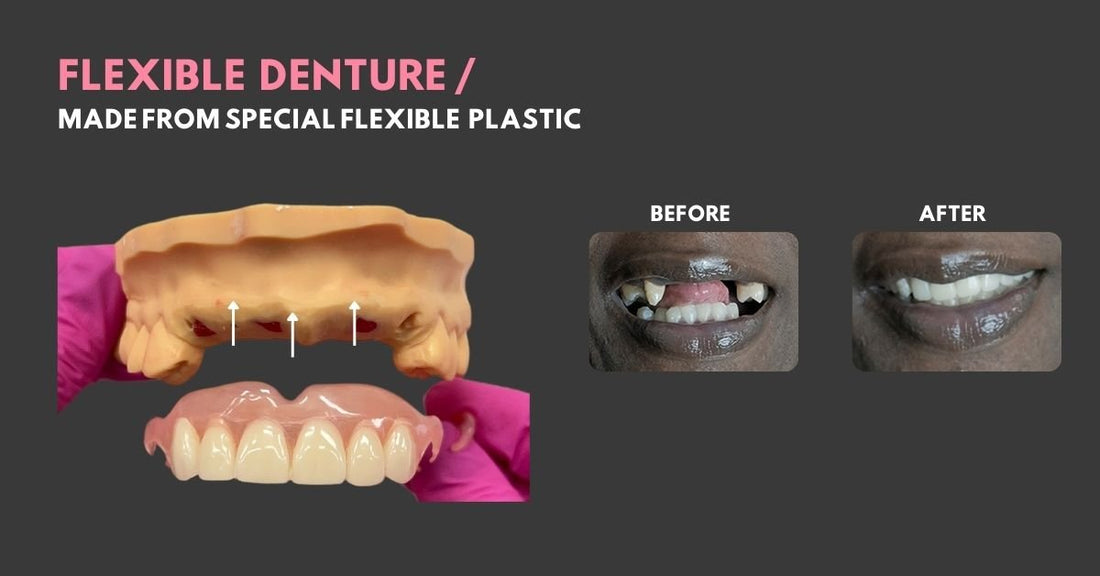Flexible Partial Dentures - Smile Lab USA