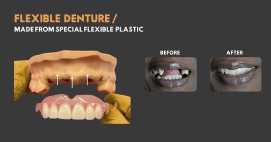 Flexible Partial Dentures - Smile Lab USA