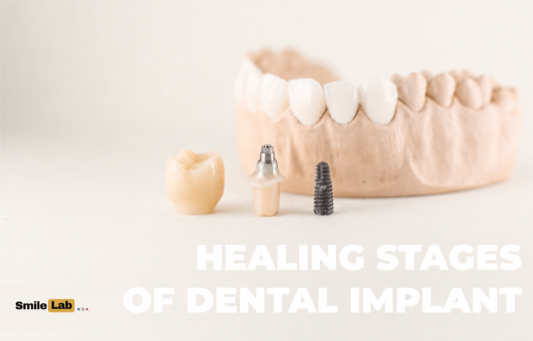 The healing stages of dental implant