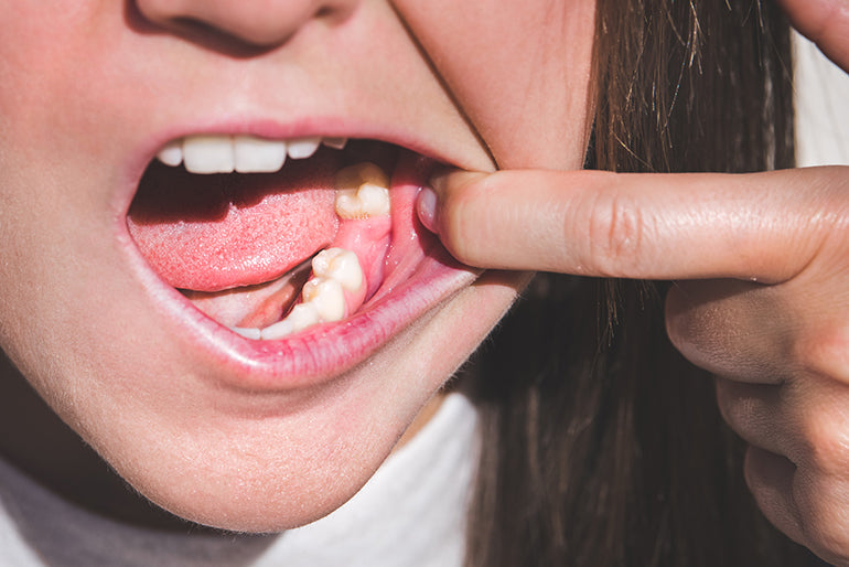 Can You Make a Dental Flipper for One Tooth?