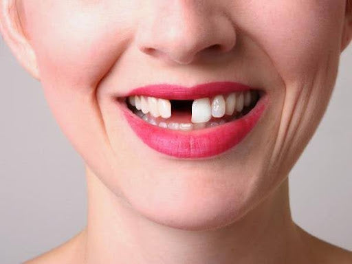 Why Osteoporosis Patients Should Avoid Dental Implants and Choose Partial Dentures or Flippers from Smile Lab USA