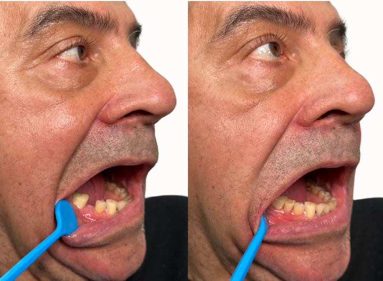 Partial dentures from Smile Lab USA