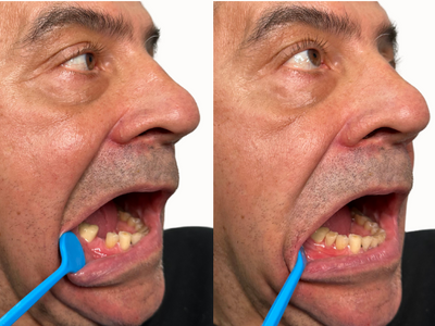 Before and after — a partial denture rebuilds a patient’s smile