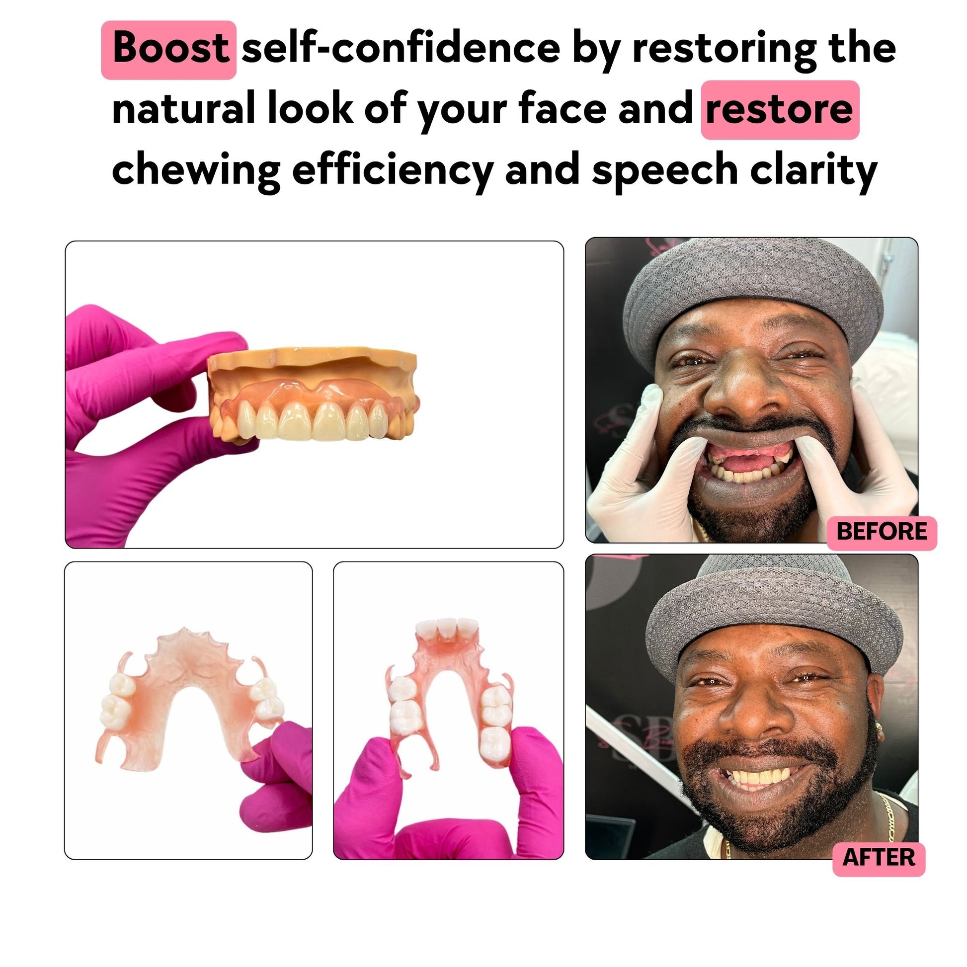 flexible_partial_denture_for_up_to_8_missing_teeth
