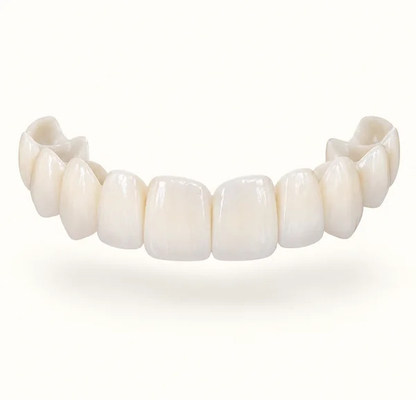 Snap-on veneers