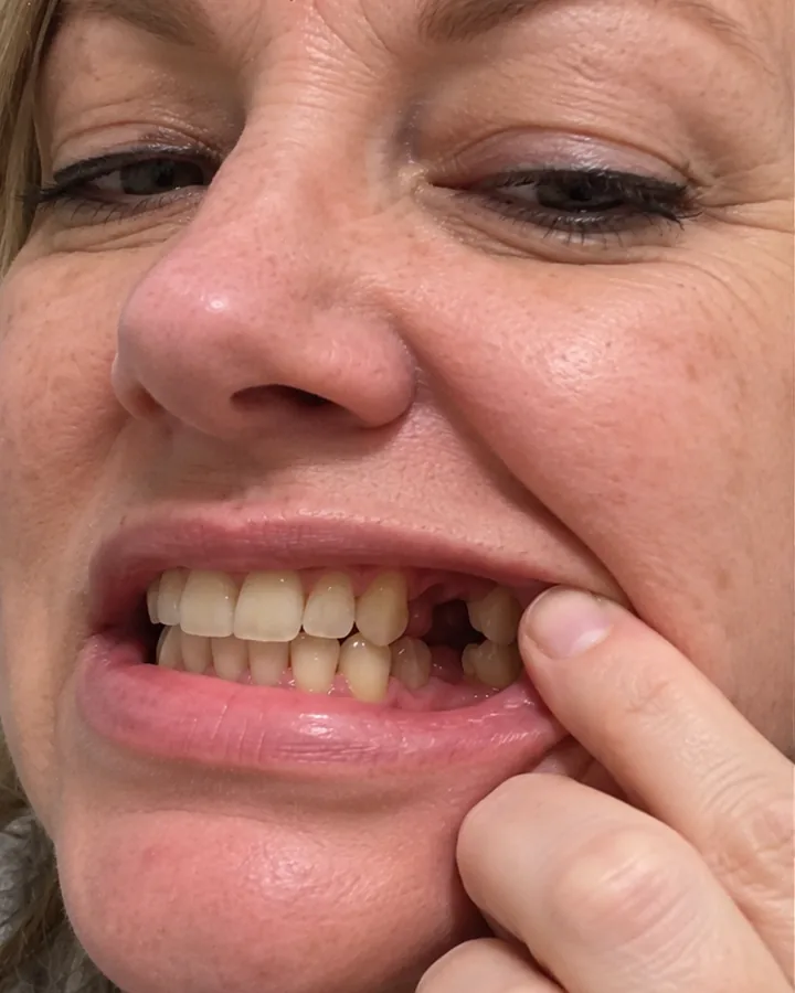 A side tooth missing, lip pulled back