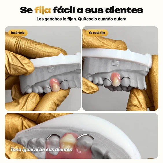 Diente postizo removible encajándose en un modelo gris con guantes dorados