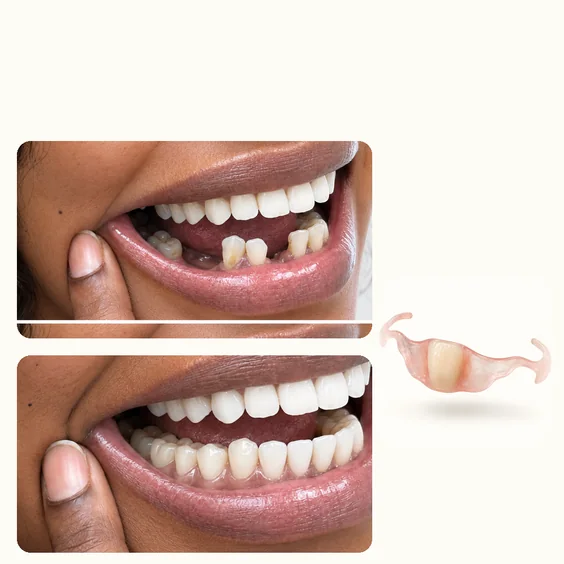Semi flex flipper before and after
