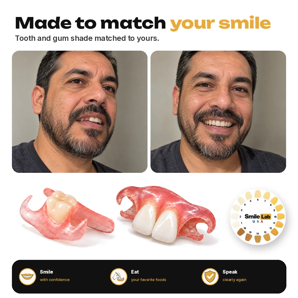 Flexible flipper matched to the tooth and gum shade, smile before and after