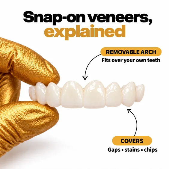 Snap-on veneers