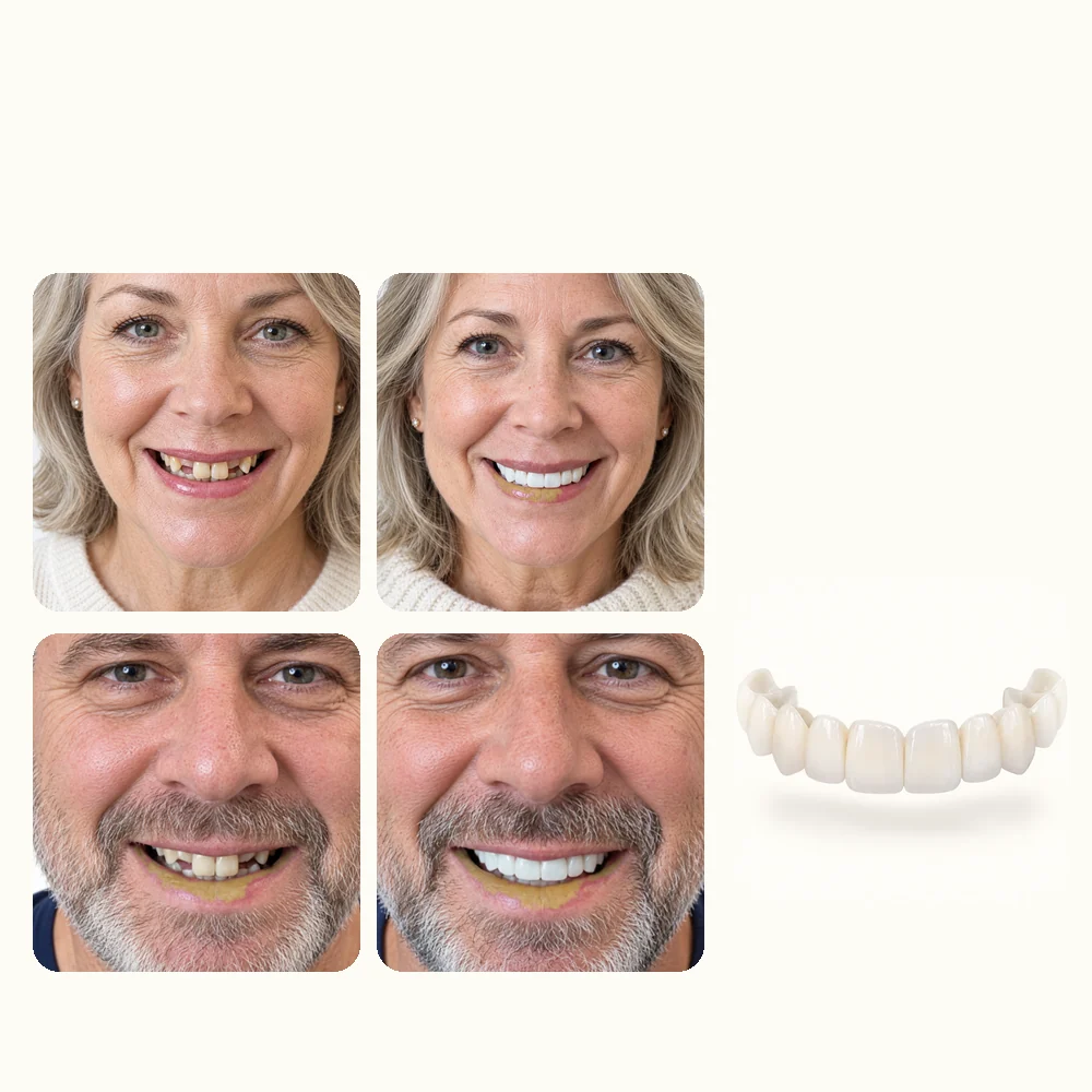 veneers-ba