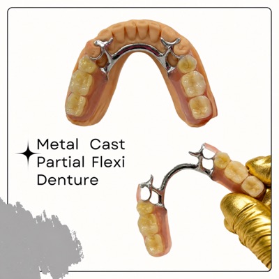 Cast metal partial denture