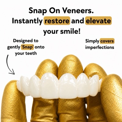 Snap-on veneers