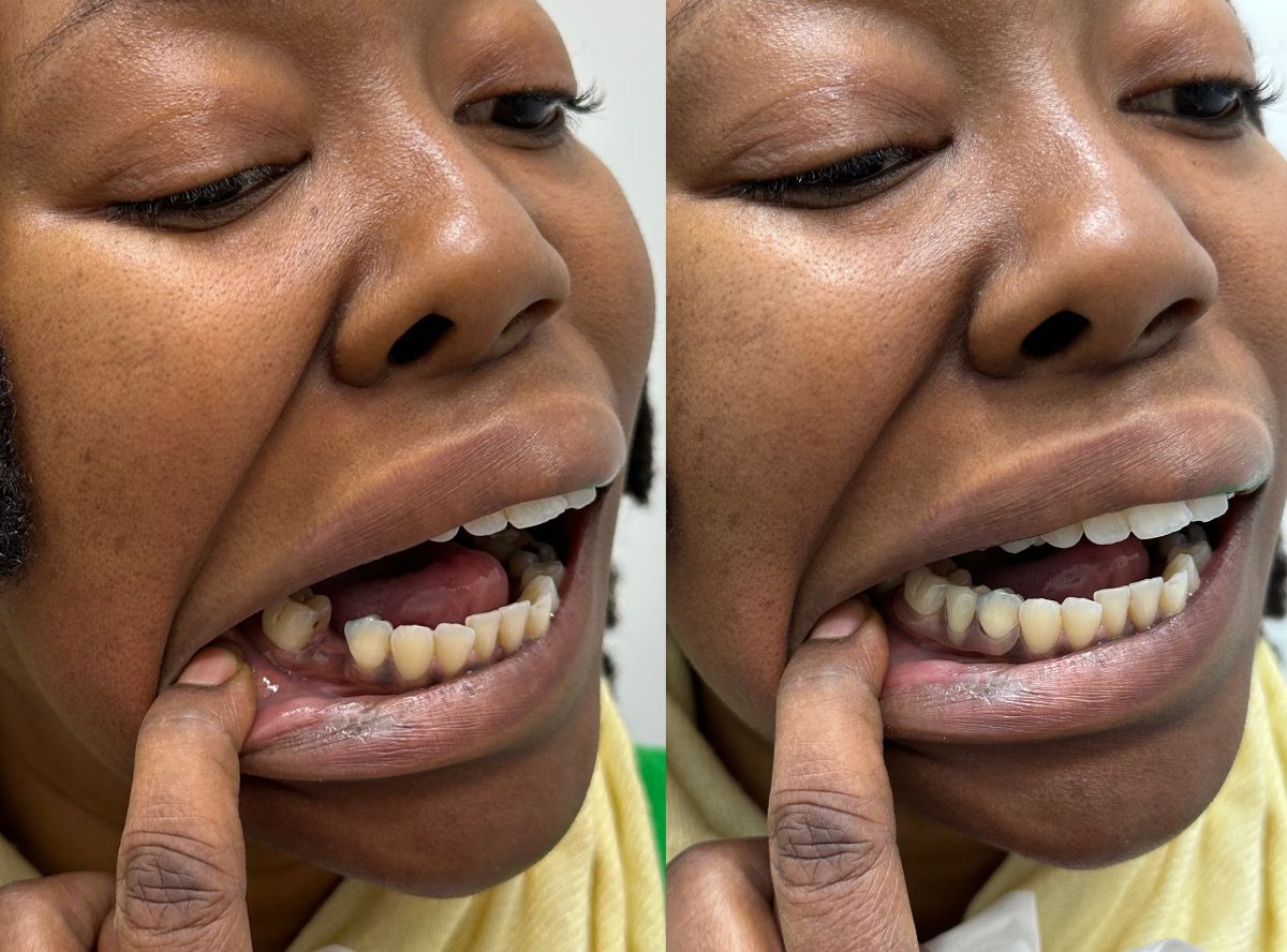 Flexi Flipper Before and After Smile Lab USA
