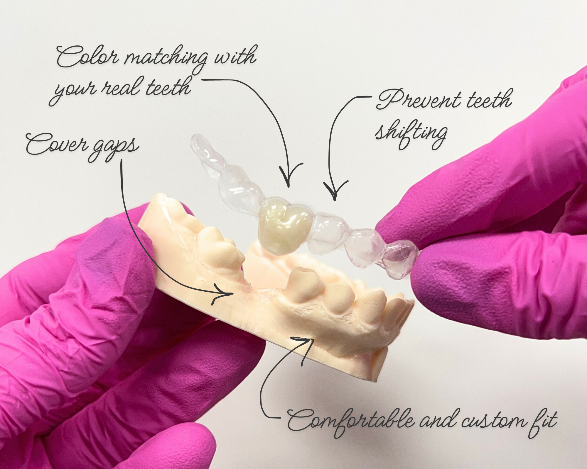 Essix Retainer with fake tooth