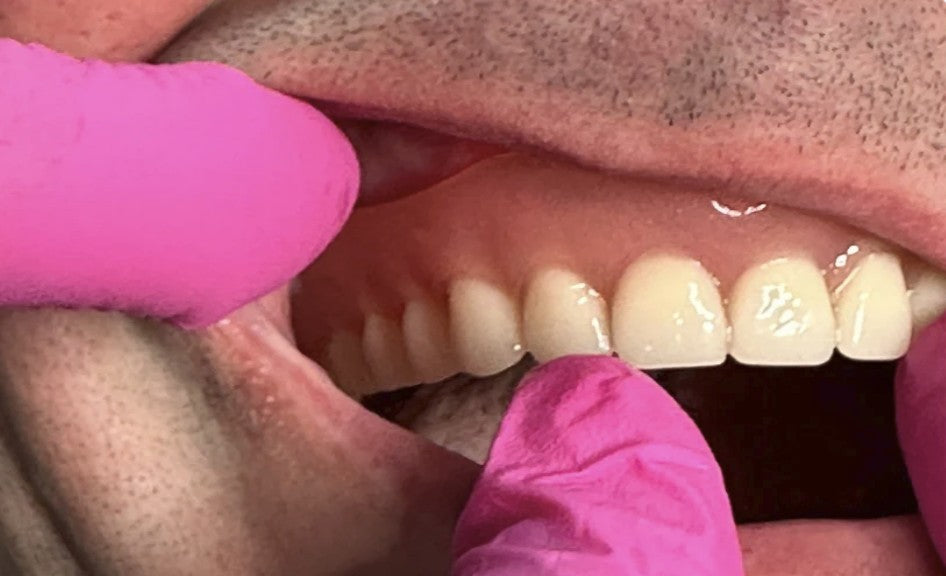 How_we_pick_your_Gum_and_Teeth_Color