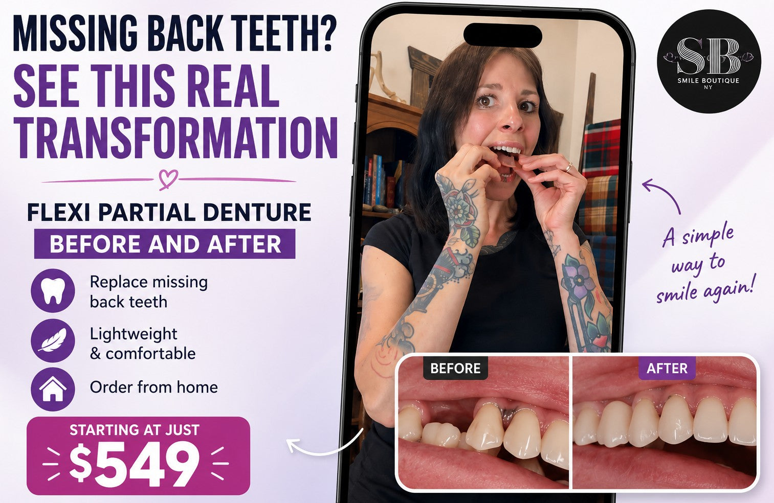 Missing back teeth before and after transformation using a custom Flexi Partial Denture from Smile Lab USA, showing smile restoration and replacement of missing teeth.