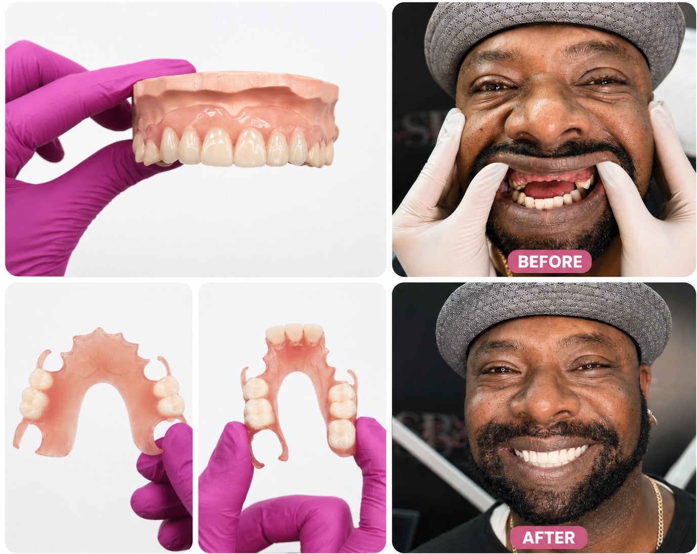 Before and after smile transformation showing a custom flexible partial denture replacing multiple missing teeth, alongside close-up views of the removable dental appliance from Smile Lab USA.