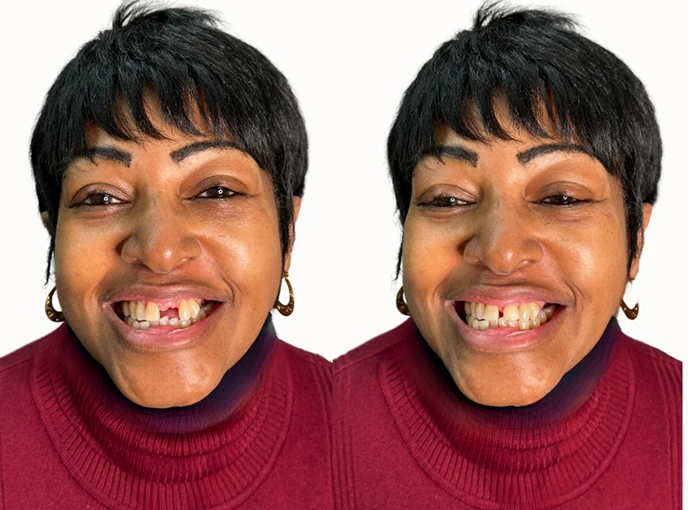 Flexible Flipper for Up to 3 Teeth - Before And After Results
