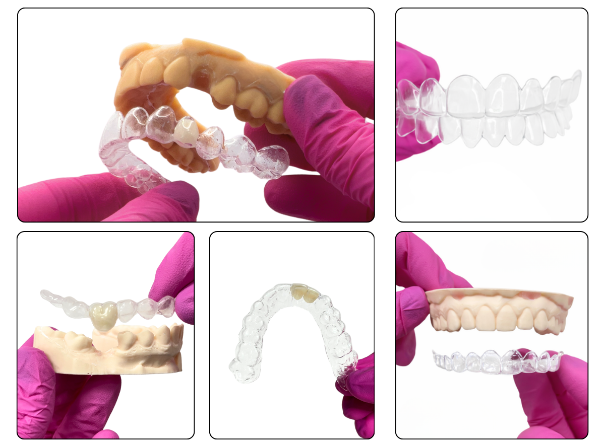 Affordable solution for missing teeth. Essix