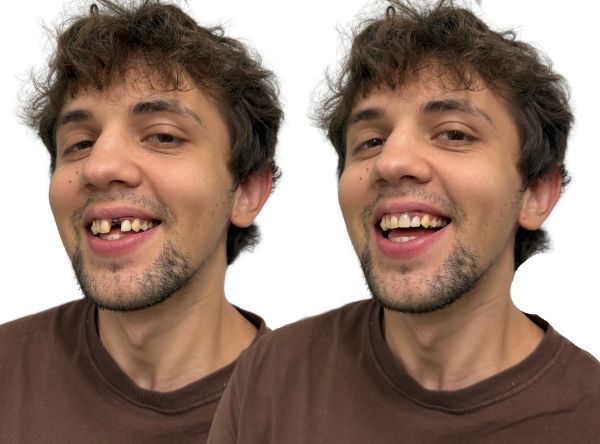 Tooth Replacement for Adults - Flipper Tooth Before And After