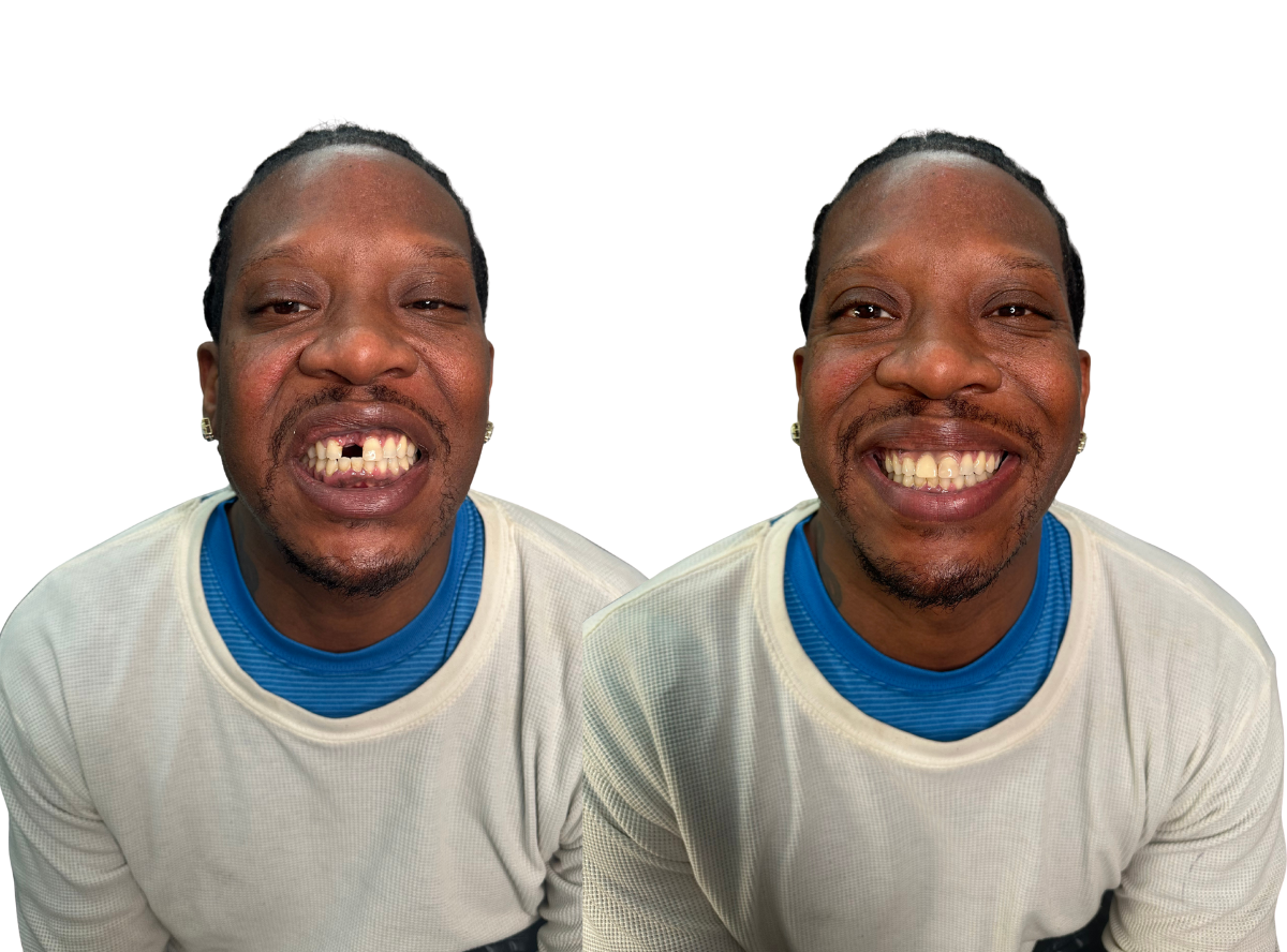 Flexible Flipper for Up to 3 Teeth | Front & Back Tooth Replacement for Adults