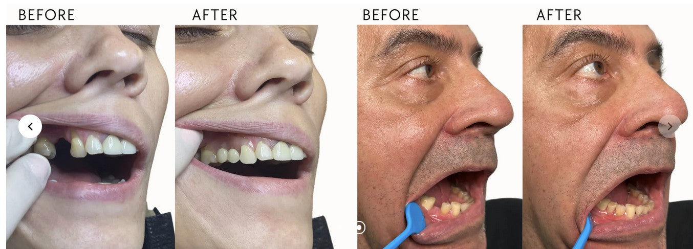 View_Before-and-After_Results_of_Flexible_Partial_Dentures