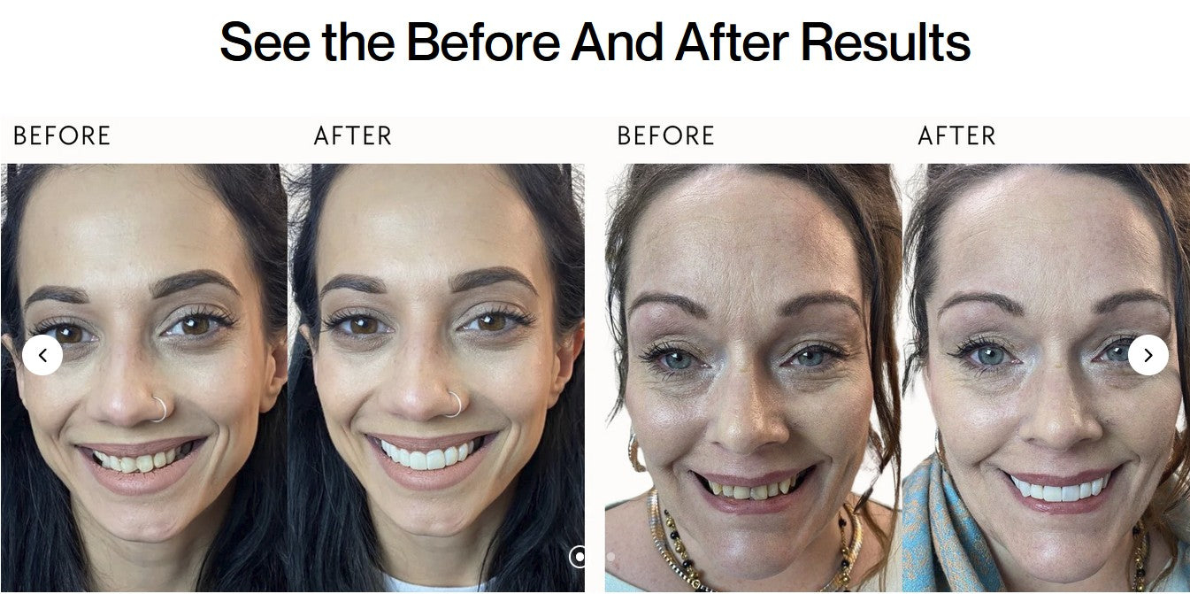 before_and_after_snap-on_veneers