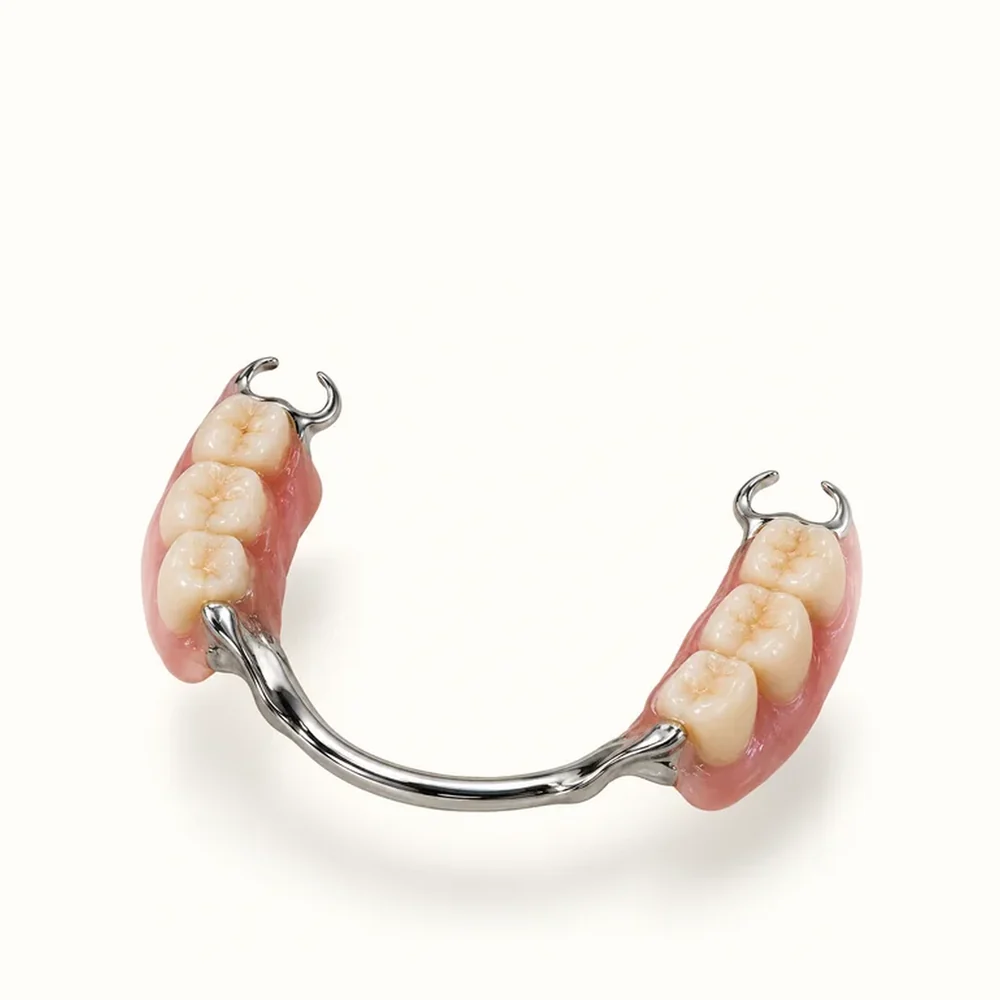 Cast metal partial denture with clasps that fits around the remaining natural teeth